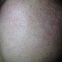 Left side of face - 8 days after IPL.