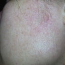 Left side of face - 8 days after IPL.