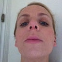 Scar healing well after a week x