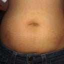 Abdomen not too much bruising but painful, pic minutes after the procedure