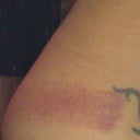 Bruising, picture taken day after the procedure. (Both sides are equally bruised)