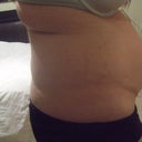 Closer up side view and bra roll before liposuction