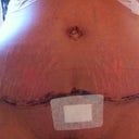 7 Days Post Op, the blue is the pen the PS used and the clumpy bits are clumps of glue as the PS also used glue as well as disolvable stitches, the plaster is just covering the drain hole