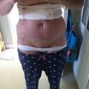 8 Days PO - redressed myself, still loadssss of swelling but going down gradually