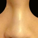 After... had some discoloration so I covered it up with concealer. Overall the results was worth it