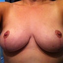 nov 15th, one week from 3 months post op