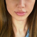 1/2012, 3 1/2 weeks post botox in jaw