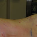 some liposuction incsision sights