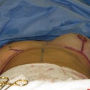one breast done,one breast not