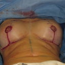 breast almost finished