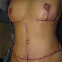 surgery complete