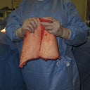 tummy skin/fat cut off Dr sd around 4lbs....didnt do amount for breast though :(