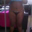 Post op day 11