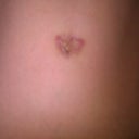 Belly button before revision.