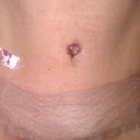 24 hours after my revision and I'm loving the results.