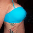 3 months post op