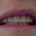 Just took photo of lip area.  The areas above and below my lips are now nicely filled. However, now the horizontal lines at the corner of my mouth really bug me.  The uneven and larger upper lip is the result of fillers years ago from a very inexperienced Doctor.  I'm hoping Dr. Grossman can correct these areas.
