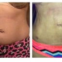 Before and 2 weeks po