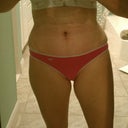TT looking better … end of 2 weeks post-op