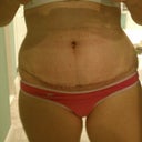 TT scar close up @ end of 2 weeks