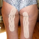 Taken 7/3/12 after reapplication of Kinesio Tape on the areas I still have small bruises.  NOTE: When I first had it applied, the tape covered almost all of the backs of my thighs and rear in fan shaped strips.