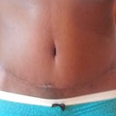 PO 7 weeks - Incision close up