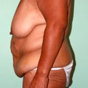 Lower Body Lift: Breast Lift, Crecent Lift, Extended Abdominoplasty