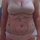Pre-op