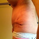 Right hip