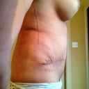 Left hip