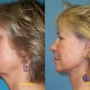Neck Lift With Fat Grafting Around The Mouth 