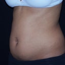 Before Zeltiq treatment