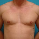 35 Year Old Man With Bilateral Gynecomastia
