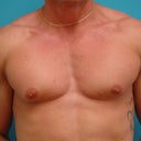 35 Year Old Man With Bilateral Gynecomastia