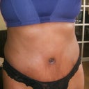 week 4 thong on... no scar :)