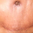 Week 4 scar healing so nicely at front