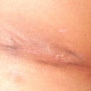 Week 4 side bit still to heal properly.  PS said will be same as front