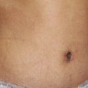 9 days post op.