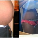 Before and After...11 Days Post Op