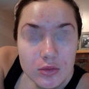 This is me after just having washed my face, still major breakout on my chin but my forehead is less inflamed and my skin feels better overall. Praying it will not get worse again.