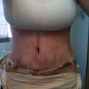 After days po, lots of bruising