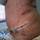Side view after 3 days po.  Can totally see the swelling, but I'm content so far