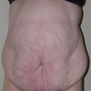 4 wk pre-op