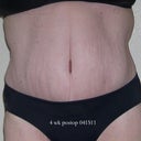 4 wk post-op