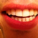 Aligner 10/20, only 5 months left to go as long as everything goes as planned. Tooth reshaping will be done last..