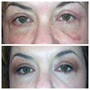 Day 14 - still a little bit of bruising and swelling but not too bad. Top picture is, of course, without makeup. Bottom picture is with a ton of makeup. Not too bad!