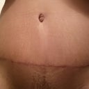 9 Weeks PO - Up close incision
