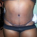 One drain was removed on this day... can you say ouch!