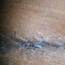 this is how my incision is looking. Its dry because I have to pass alcohol on it every day. It also have the tape on it.