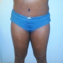 You can see the swelling on my upper torso. My garment is not tight up there at all and I can not stand the way that part look. See how shinny it is. Gpnna get that taken cared of on monday I hope